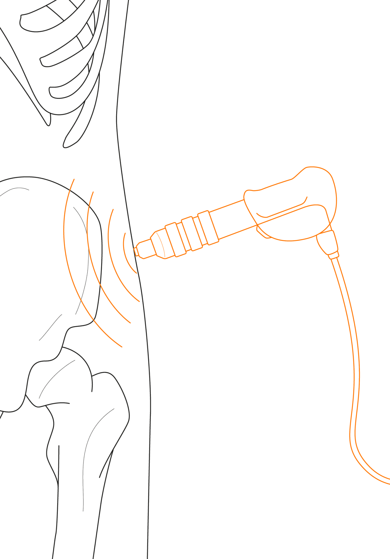 Stosswellenbehandlungen